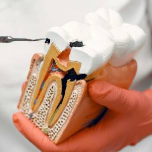 Top Signs You Might Need a Root Canal in Brentwood